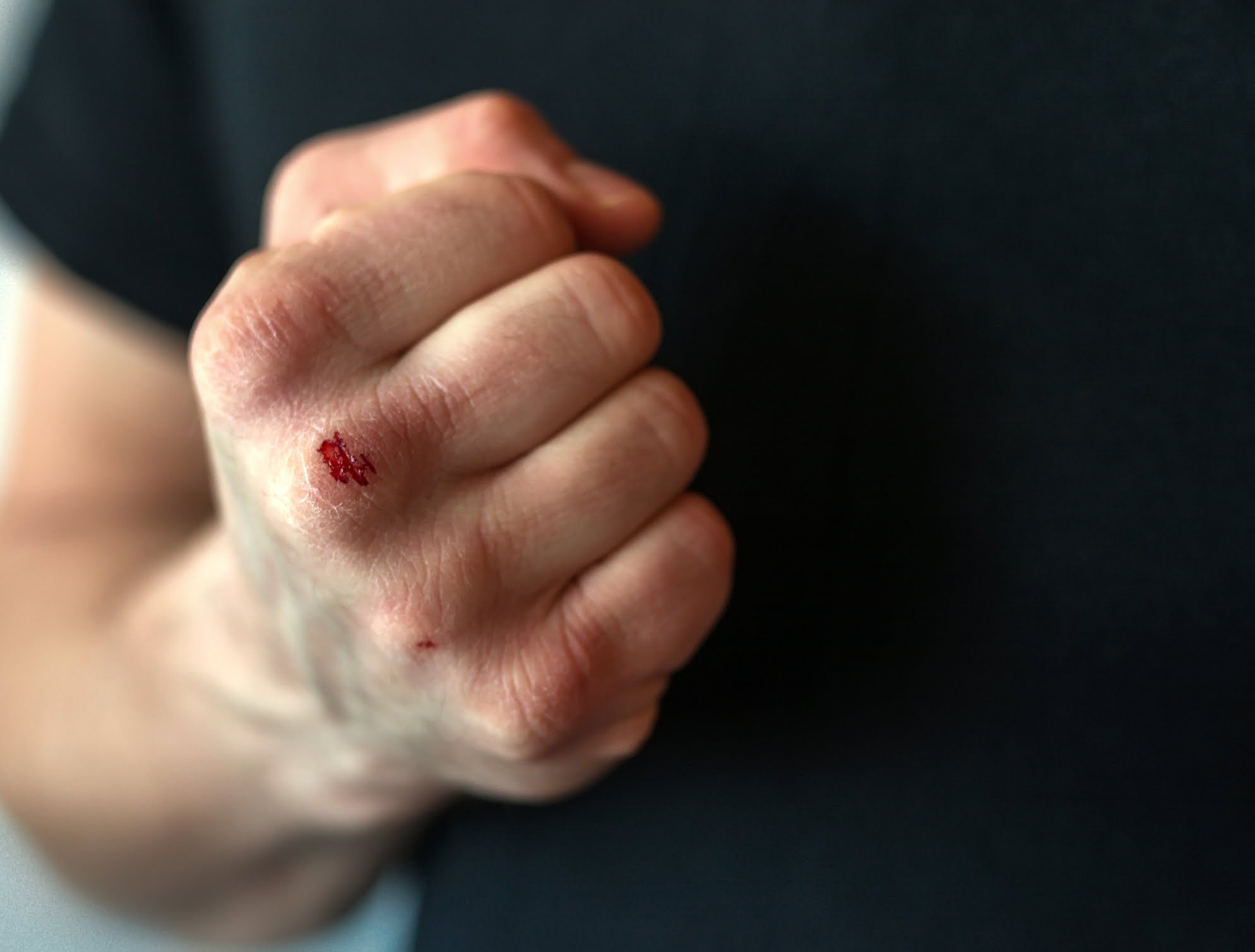 A bloody fist used to illustrate Assault vs Battery